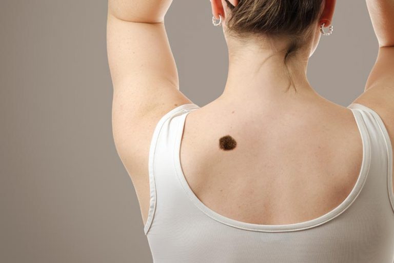 Cilt kanserine çözüm geliştirildi!