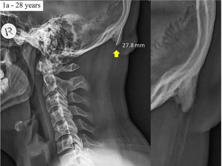 Bilim insanları, kafatasında boynuz keşfetti