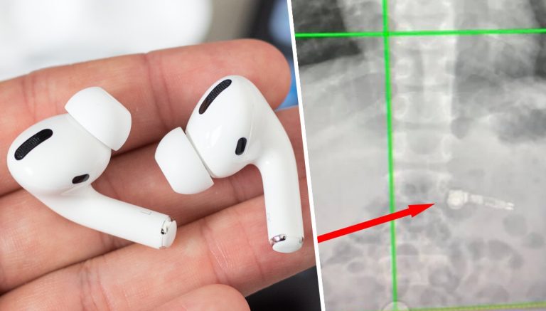 7 yaşındaki çocuk AirPods yuttu! İşte yaşananlar