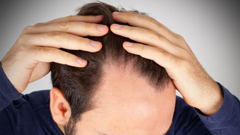 Saç dökülmesinin önemli bir nedeni keşfedildi