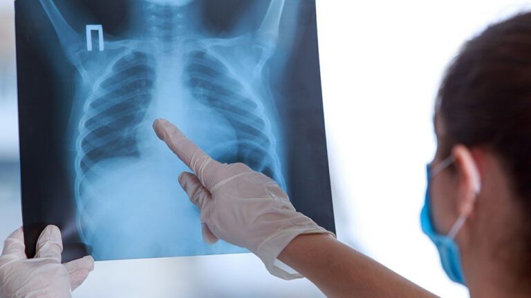 Google’dan çığır açan tüberküloz uygulaması