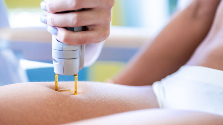 Lazer epilasyon cihazları nasıl çalışıyor?