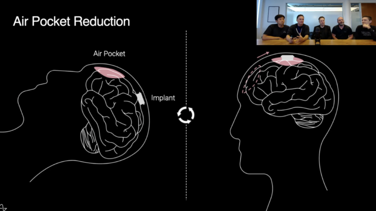 Neuralink ikinci insan hasta üzerinde çipi nasıl takacağı belli oldu. Şirket yeni yapılacak ameliyattan detayları paylaştı.