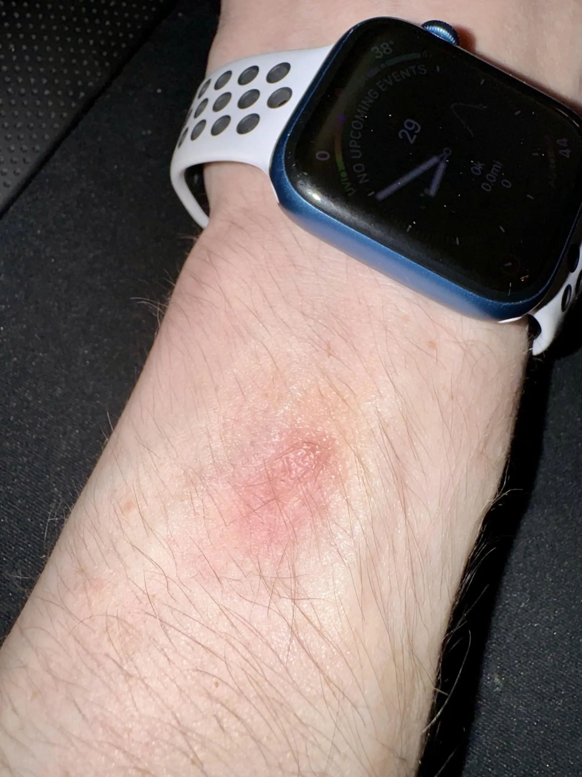 Apple Watch Kullanıcıları Tedirgin: Cilt Tahrişine Neden Oluyor — Apple Watch cilt tahrişi, Apple Watch kordonu alerji yapar mı, akıllı saat bilek kızarıklığı, Apple Watch temizliği nasıl yapılır, akıllı saatlerde cilt hassasiyeti